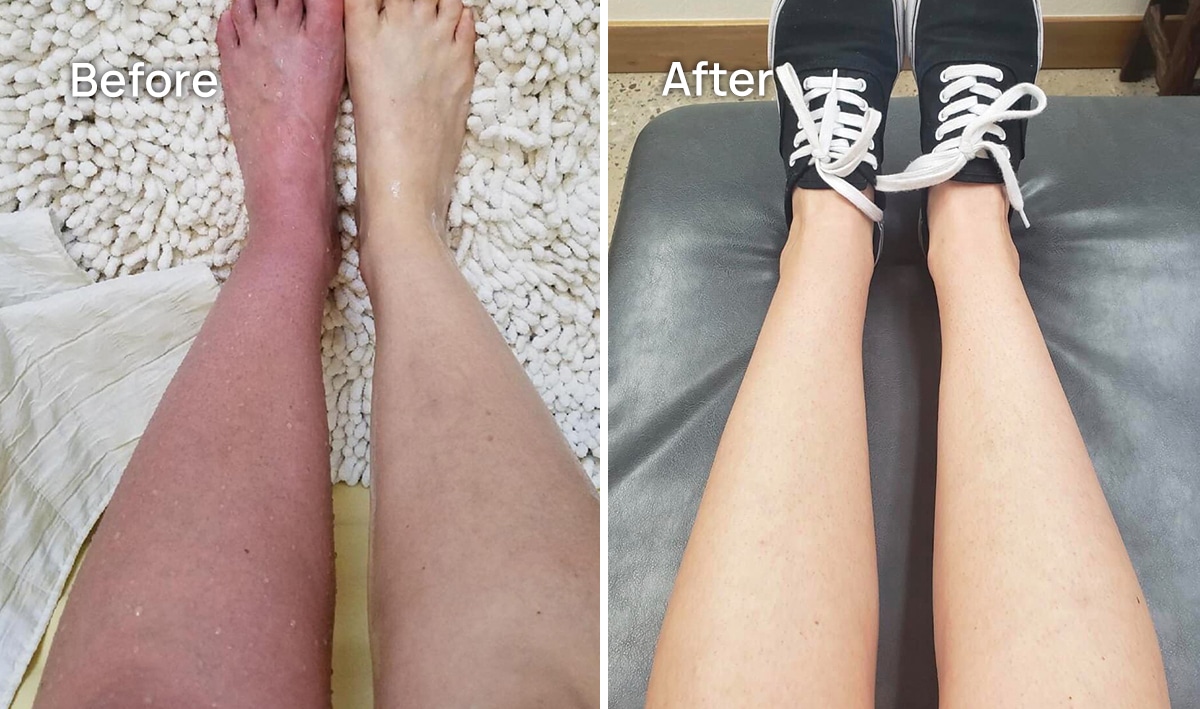 leg CRPS Treatment before and after