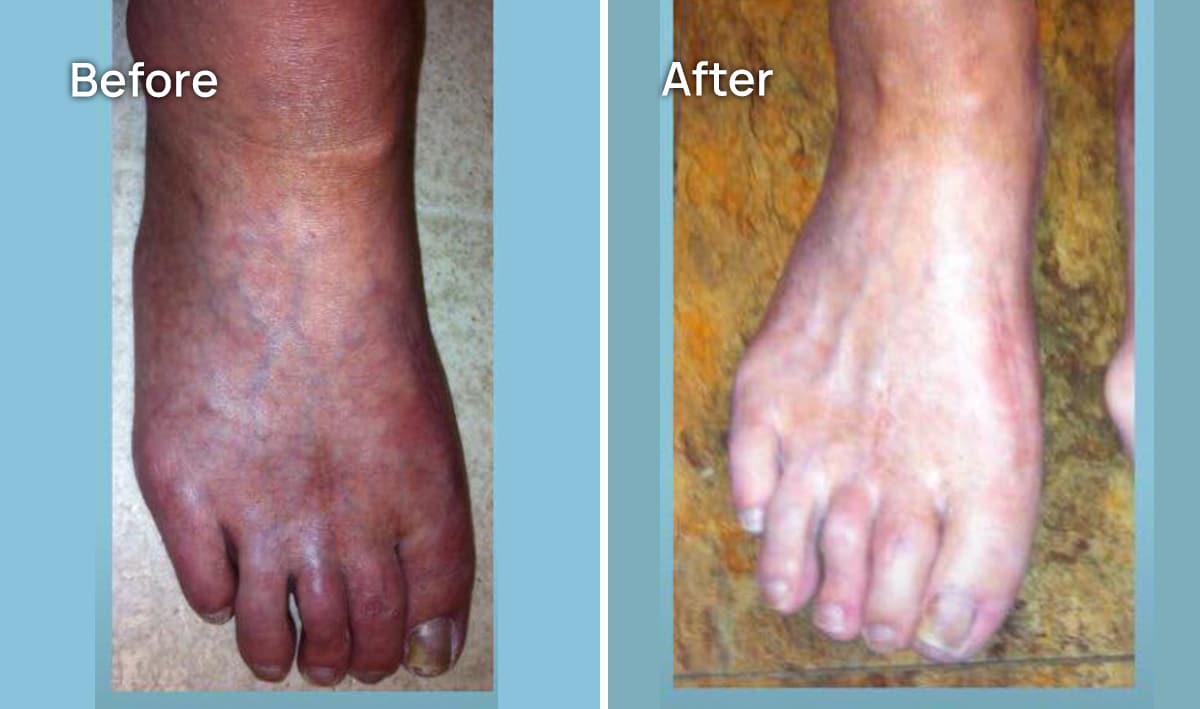 Foot CRPS Treatment before and after