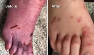 crps patient before and after