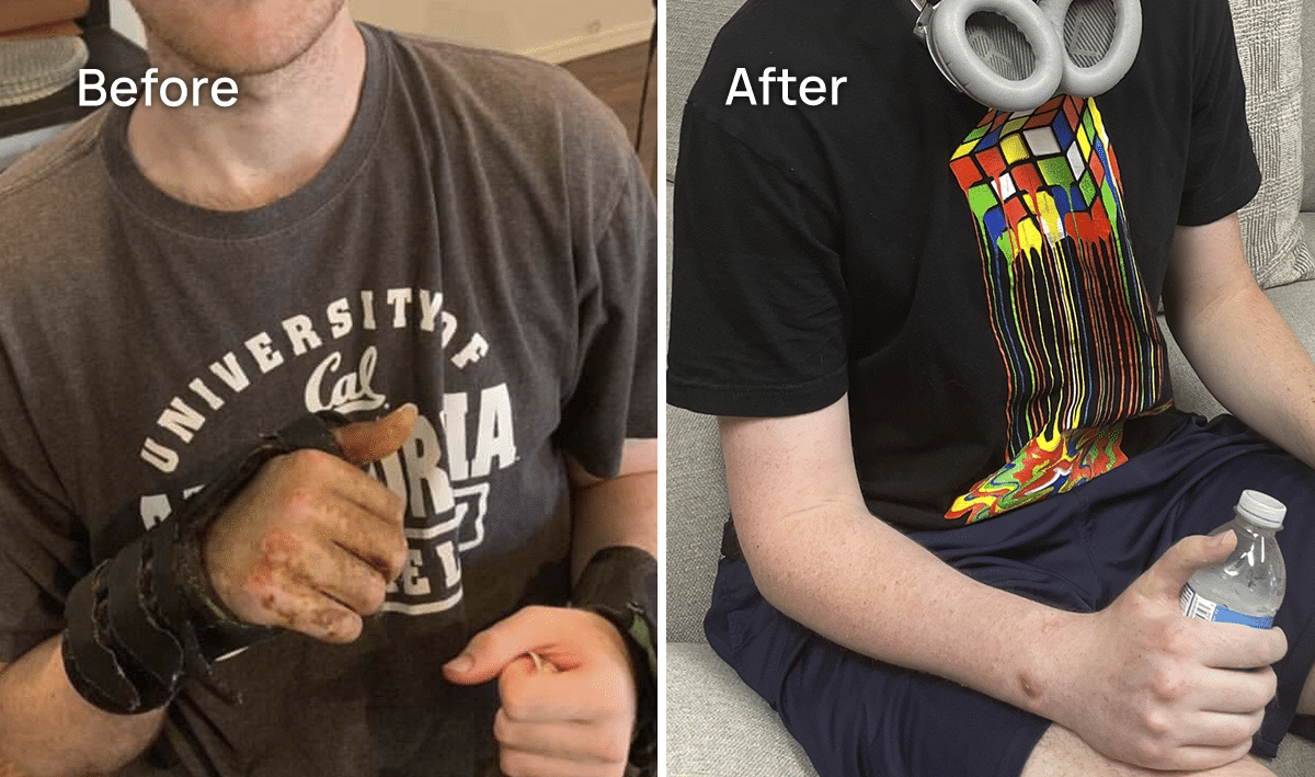 CRPS Treatment Before and After - Male Arm Close Up