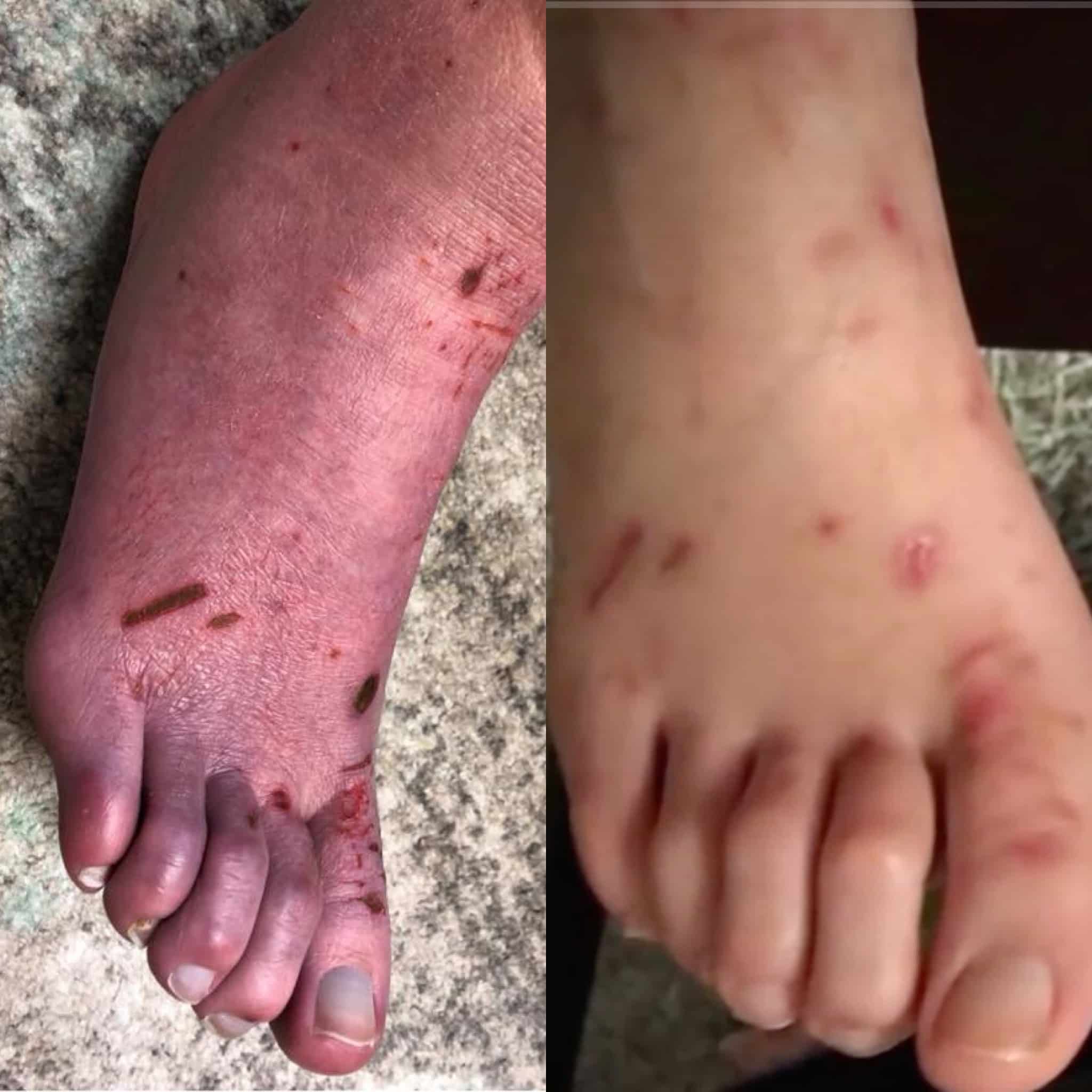 Dr eric deals berg plantar fasciitis