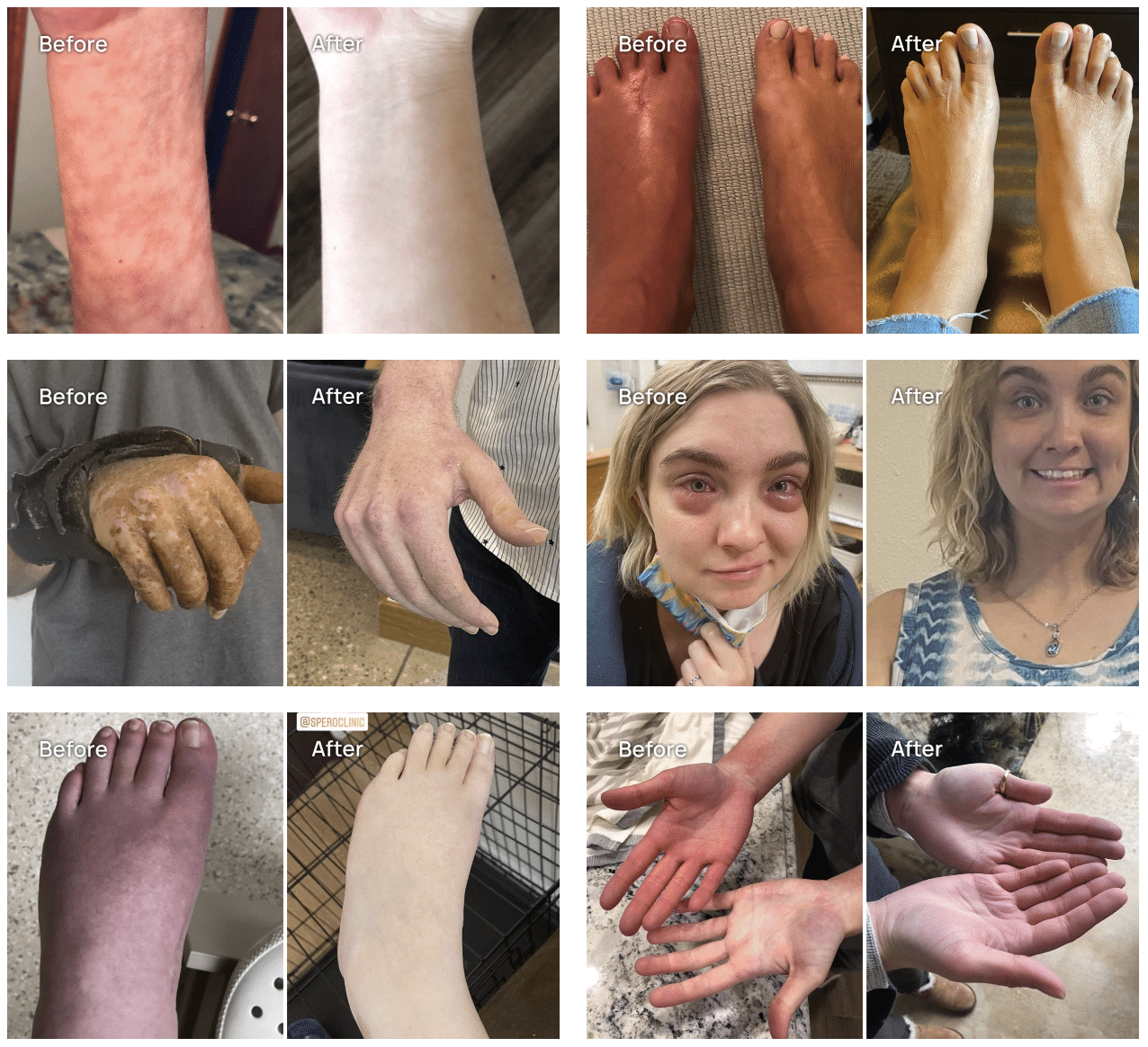 Spero Clinic CRPS Treatment Before and Afters