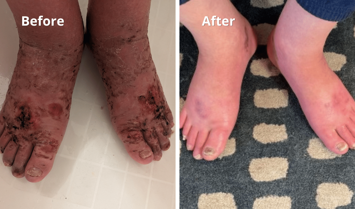 CRPS Before and After Foot Ankle - Spero Clinic - Troy