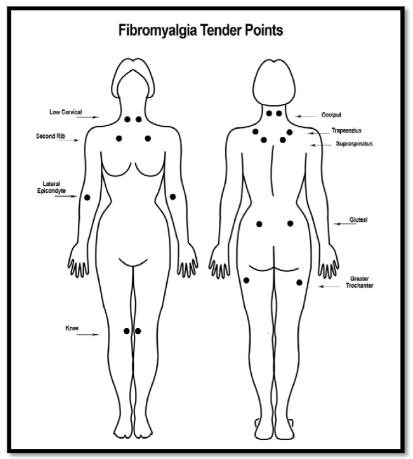 tender points fibromyalgia chronic pain