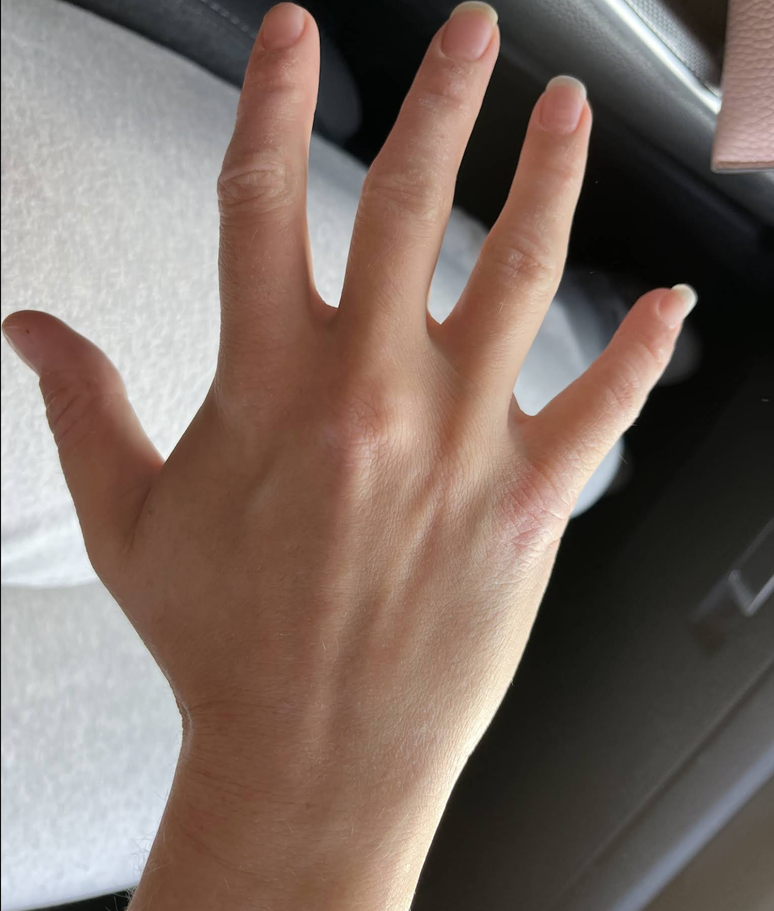The Spero Clinic reviews - Kate Rowan Eczema Dermatitis Patient after treatment 2
