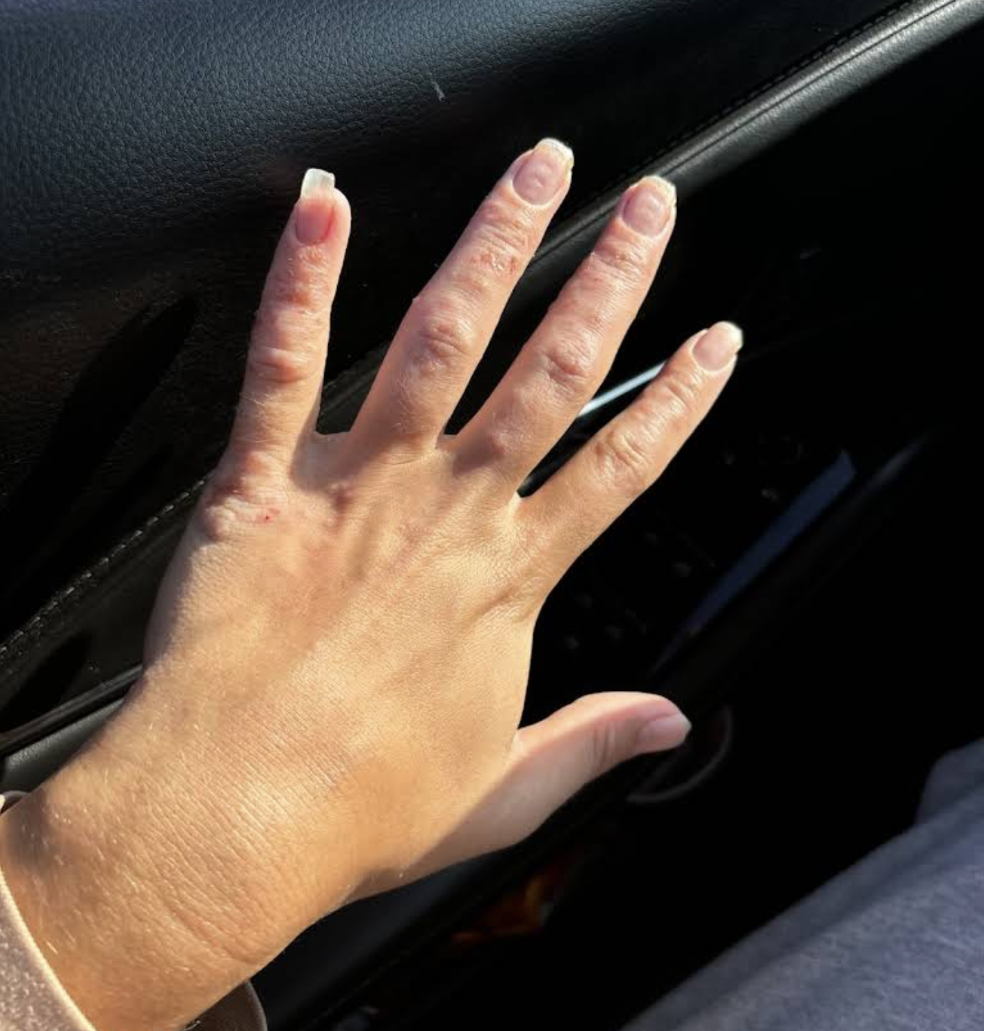 The Spero Clinic reviews - Kate Rowan Eczema Dermatitis Patient Before treatment 1